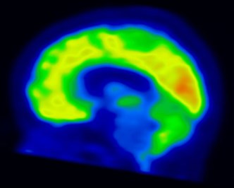 Pet Scan of the Brain