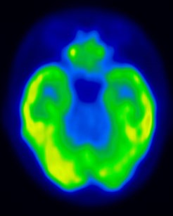PET Scan of the Brain